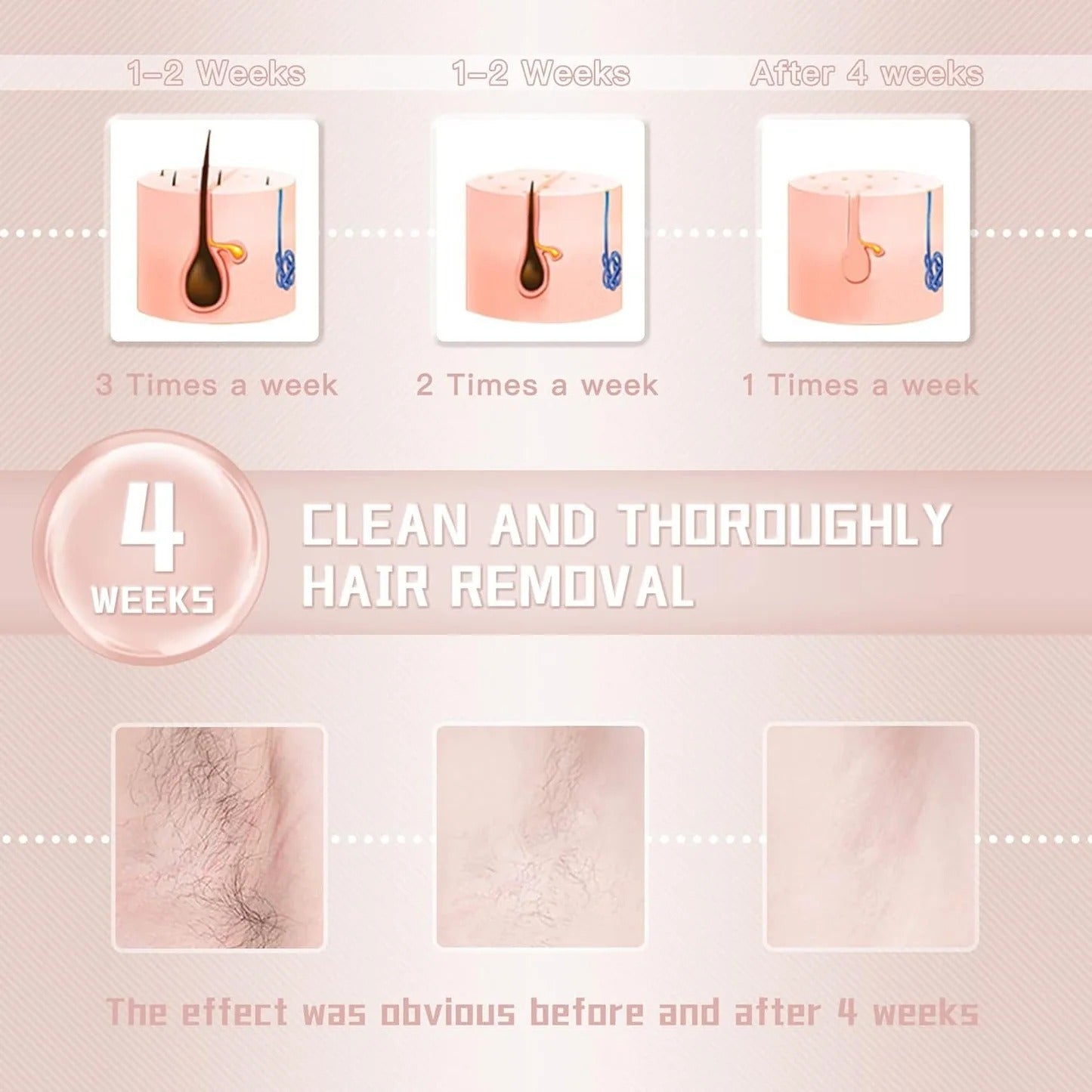 IPL Laser Hair Removal Device for Women
